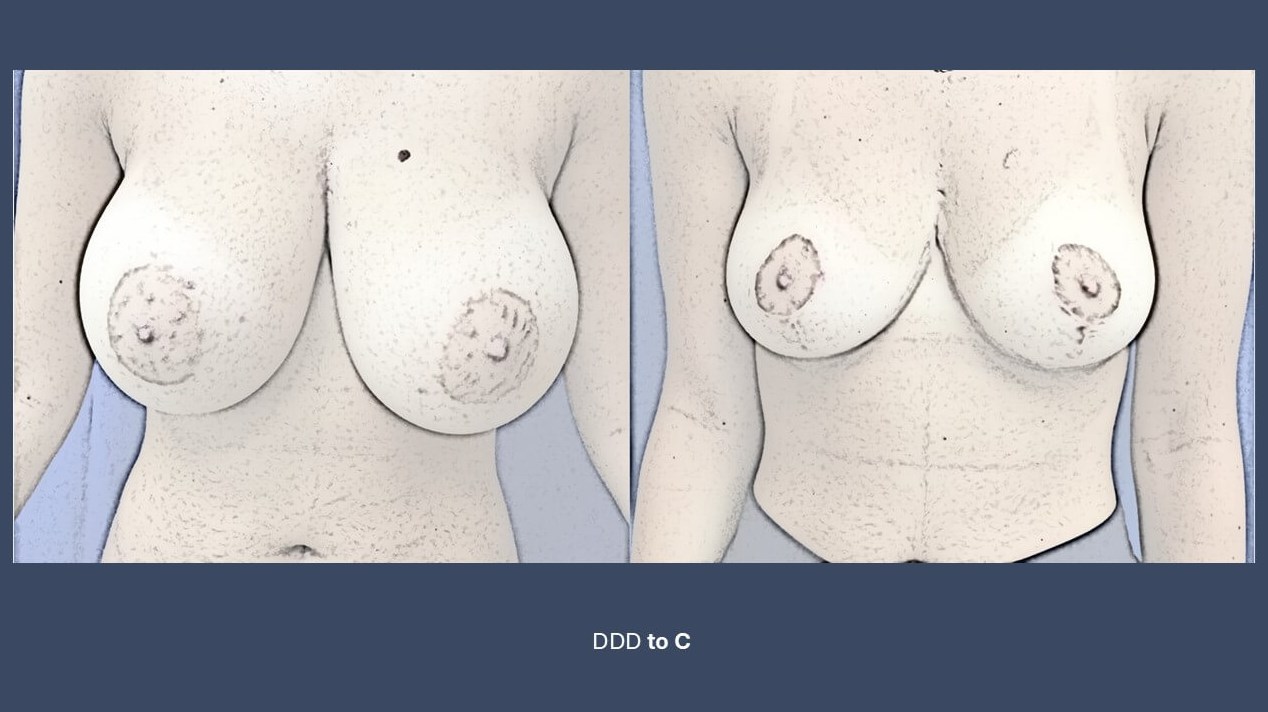 Dr. Suzman Breast Reduction Be
